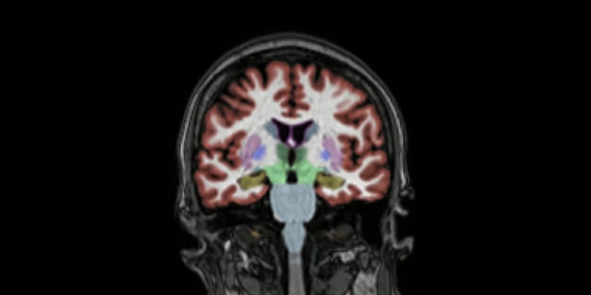 Alzheimer cervello