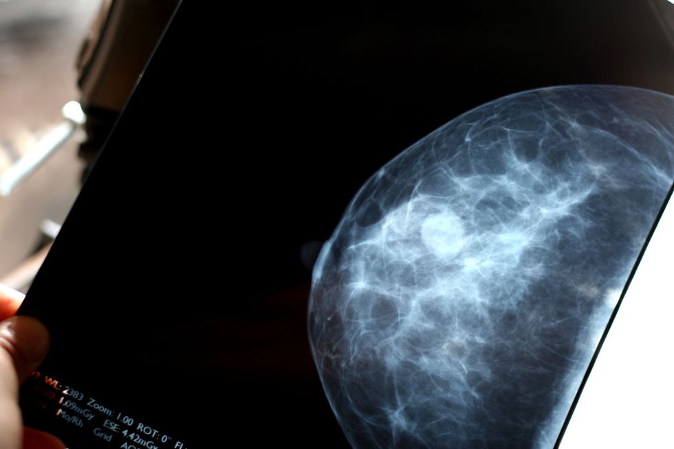 Tumore al seno: le nuove scoperte sul rischio genetico
