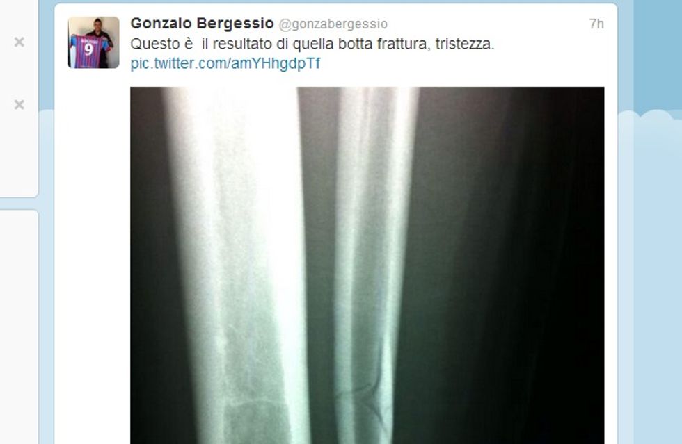 Bergessio-choc: gamba rotta e lastra su Twitter