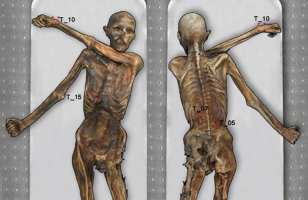 I tatuaggi della Mummia dei Ghiacci: possibili segni di agopuntura