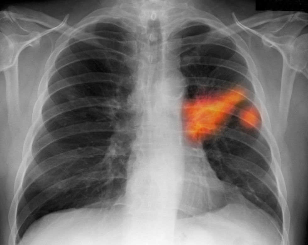 Tumore al polmone: si allunga l’aspettativa di vita grazie all’immunoterapia