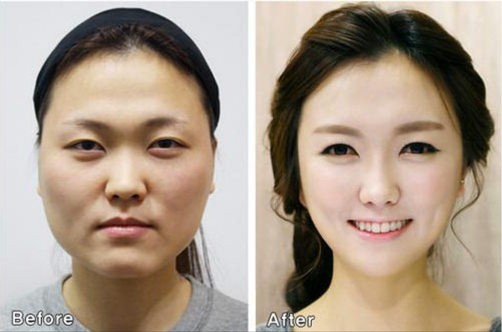 I miracoli estetici dei chirurghi sudcoreani