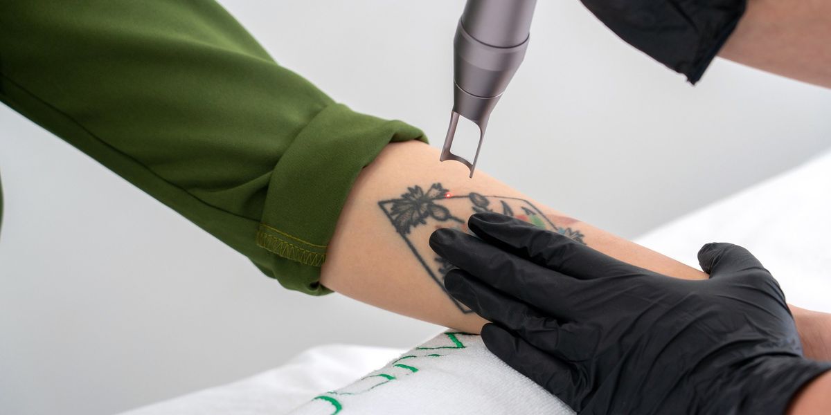 ​rimozione tatuaggio