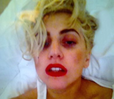 Lady gaga mostra l’occhio nero ai fan