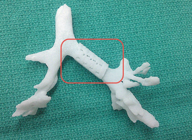 Il bambino che respira… grazie a una stampante 3D