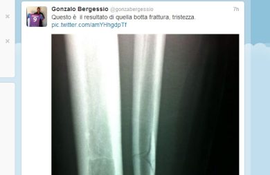 Bergessio-choc: gamba rotta e lastra su Twitter
