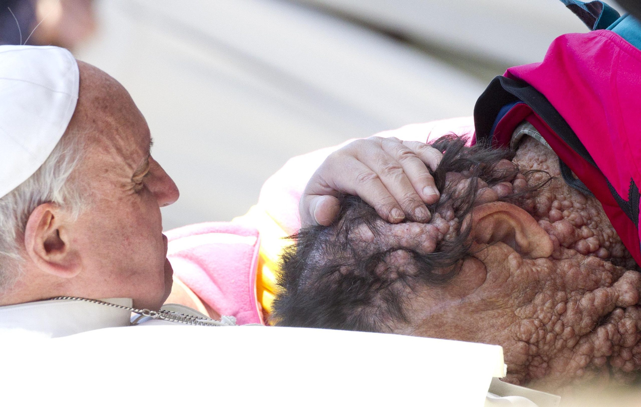 Esclusiva Panorama: Parla Vinicio, l’uomo sfigurato baciato da Francesco
