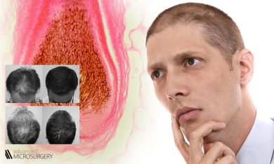 Caduta capelli e diradamento: la cura definitiva della calvizie è possibile?