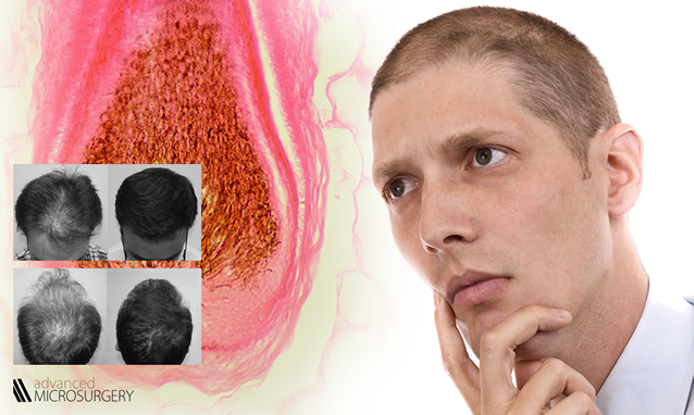 Caduta capelli e diradamento: la cura definitiva della calvizie è possibile? Caduta capelli e diradamento: la cura definitiva della calvizie è possibile?