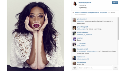 Chantelle Winnie, la modella con la vitiligine che ha conquistato le passerelle