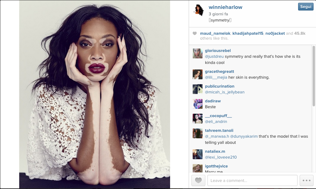 Chantelle Winnie, la modella con la vitiligine che ha conquistato le passerelle
