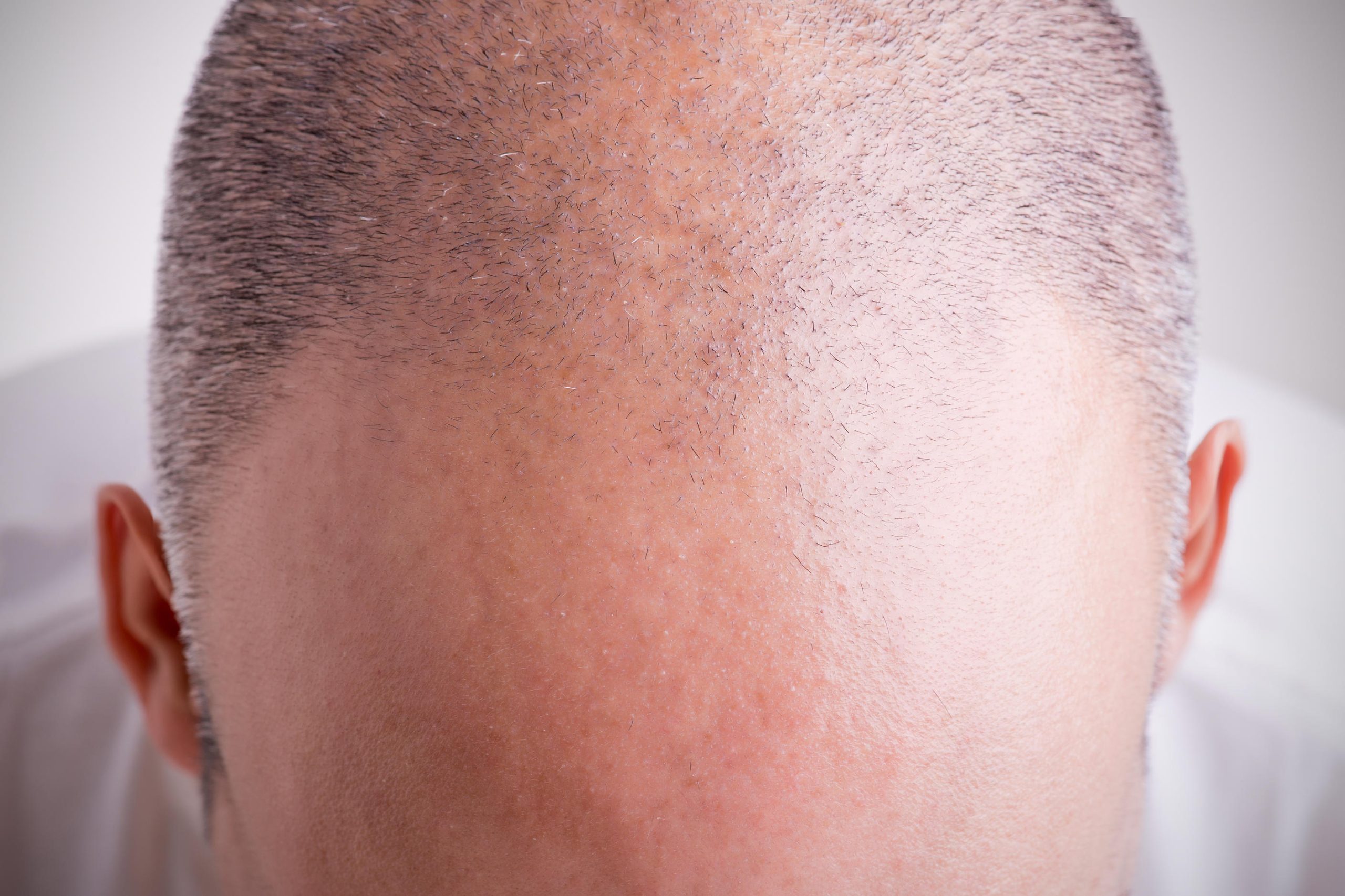 Calvizie: scoperti principi attivi che fanno ricrescere i capelli rapidamente