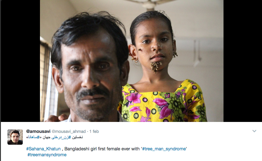 In Bangladesh la prima bimba affetta dalla sindrome dell’uomo-albero In Bangladesh la prima bimba affetta dalla sindrome dell’uomo-albero