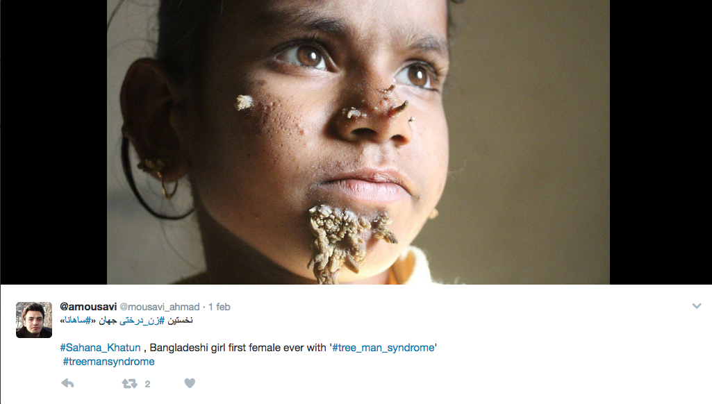 In Bangladesh la prima bimba affetta dalla sindrome dell’uomo-albero In Bangladesh la prima bimba affetta dalla sindrome dell’uomo-albero