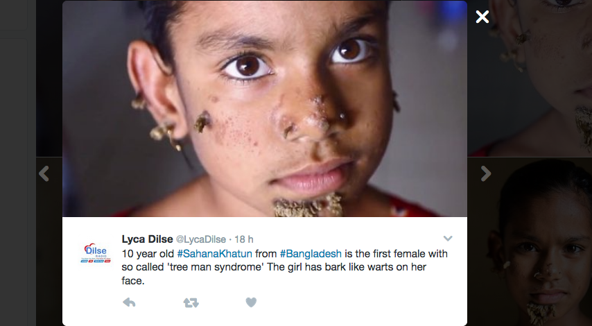 In Bangladesh la prima bimba affetta dalla sindrome dell’uomo-albero In Bangladesh la prima bimba affetta dalla sindrome dell’uomo-albero