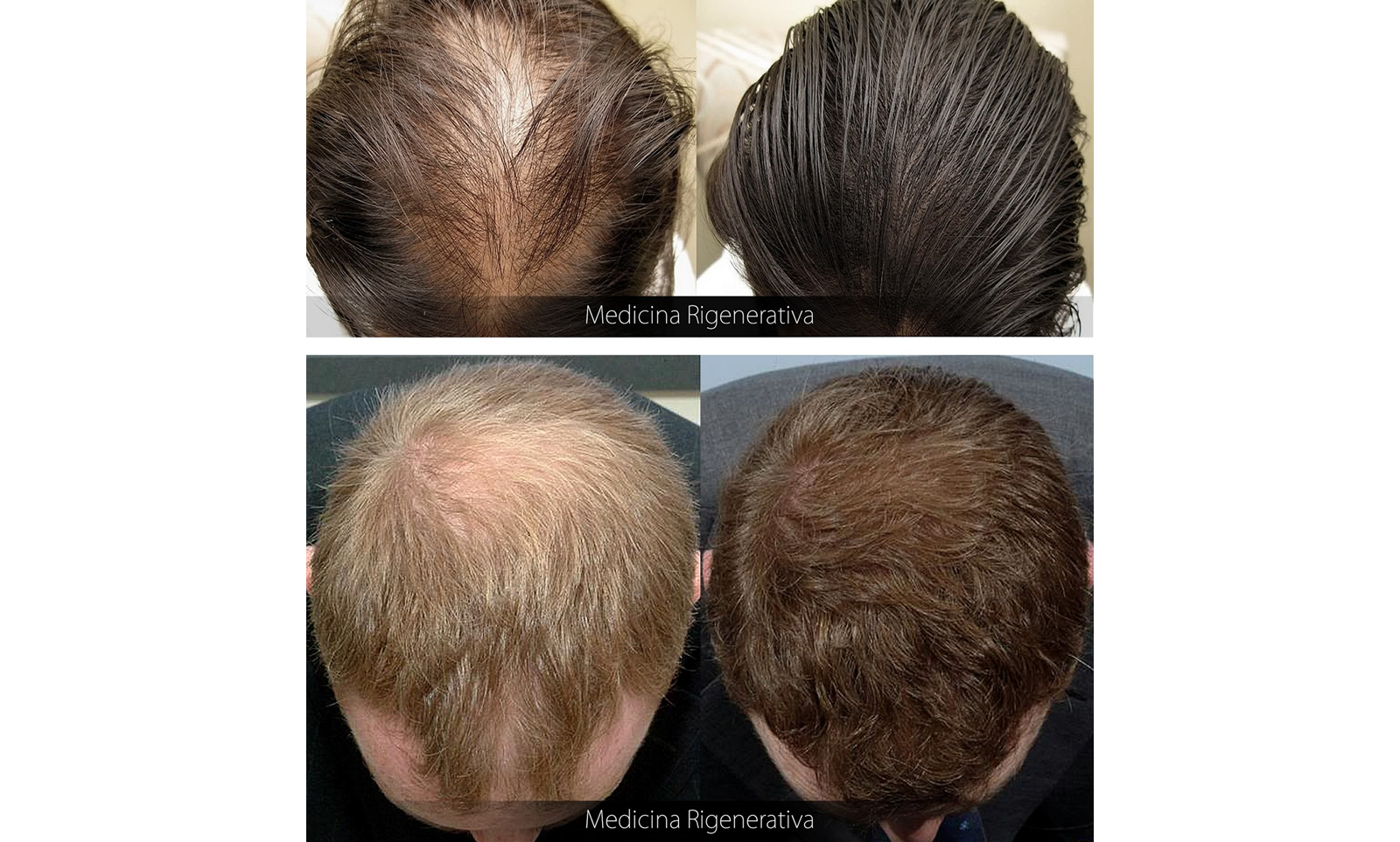 Ricrescita dei Capelli con la Rigenerazione Cellulare è possibile? Ricrescita dei Capelli con la Rigenerazione Cellulare è possibile?