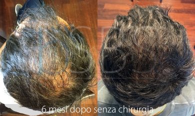 Ricrescita dei Capelli con la Rigenerazione Cellulare è possibile?