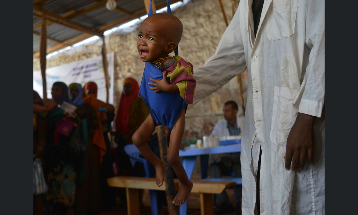 Fame nel mondo: 108 milioni di malnutriti nel 2016