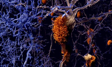 Alzheimer: cos’è, come si manifesta, le cure allo studio