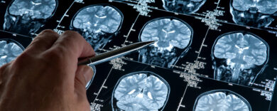 Ictus, ridurre le recidive: la scoperta che potrebbe cambiare la prevenzione