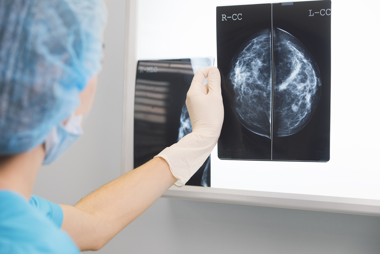 L’obesità aumenta le probabilità di morire per cancro al seno L’obesità aumenta le probabilità di morire per cancro al seno