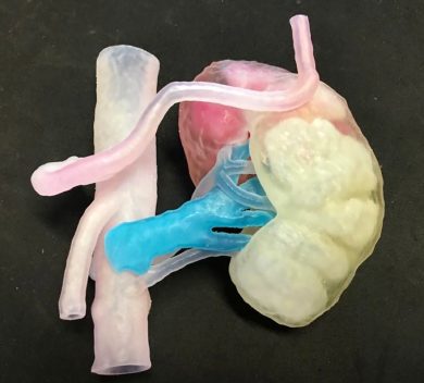 Un rene nuovo stampato in 3d