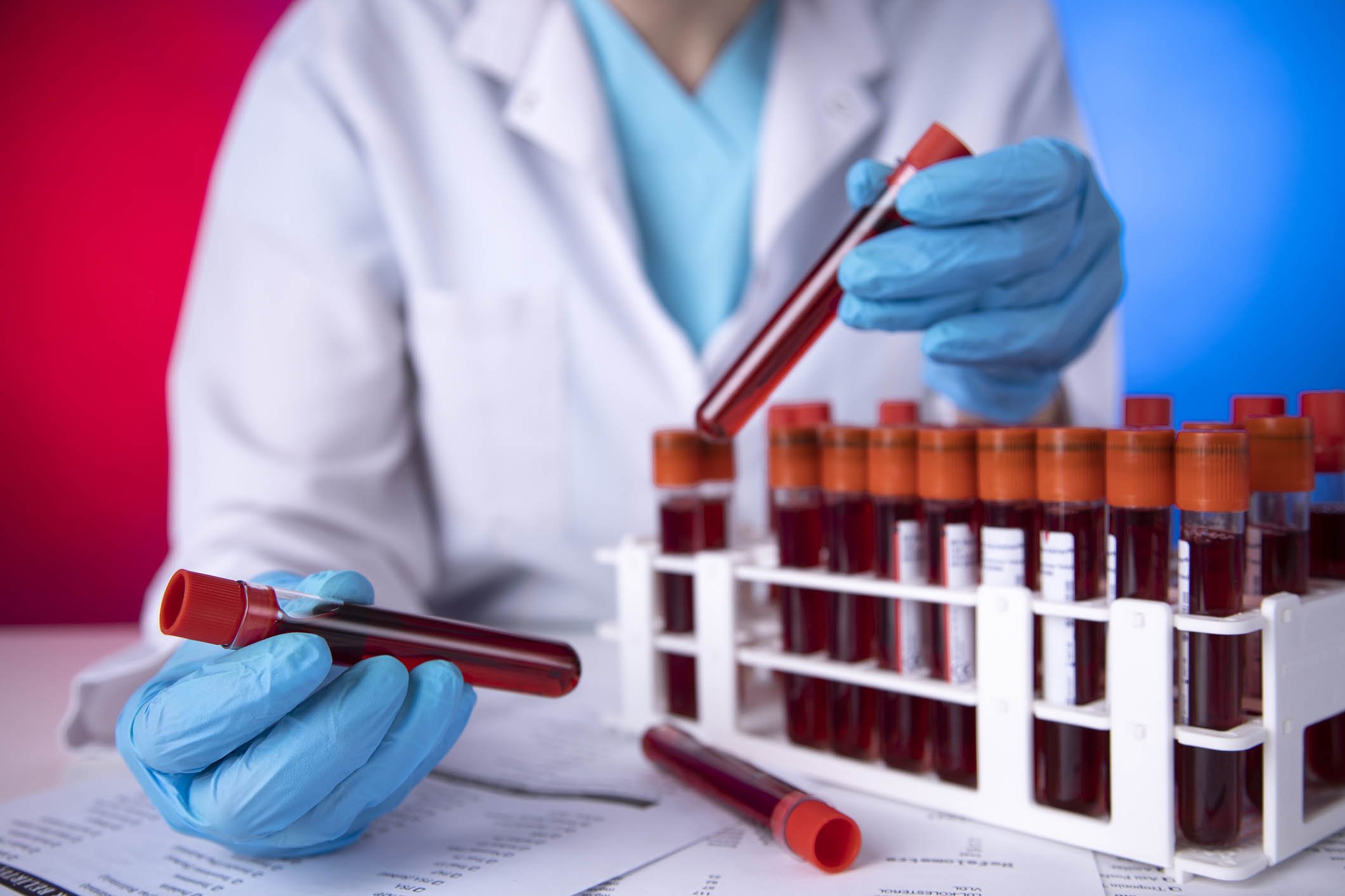 Alzheimer, la diagnosi precoce ora si fa con un test del sangue Alzheimer, la diagnosi precoce ora si fa con un test del sangue
