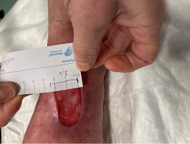 Cura delle lesioni della cute: l’avanguardia è nella stampa 3D-SLS