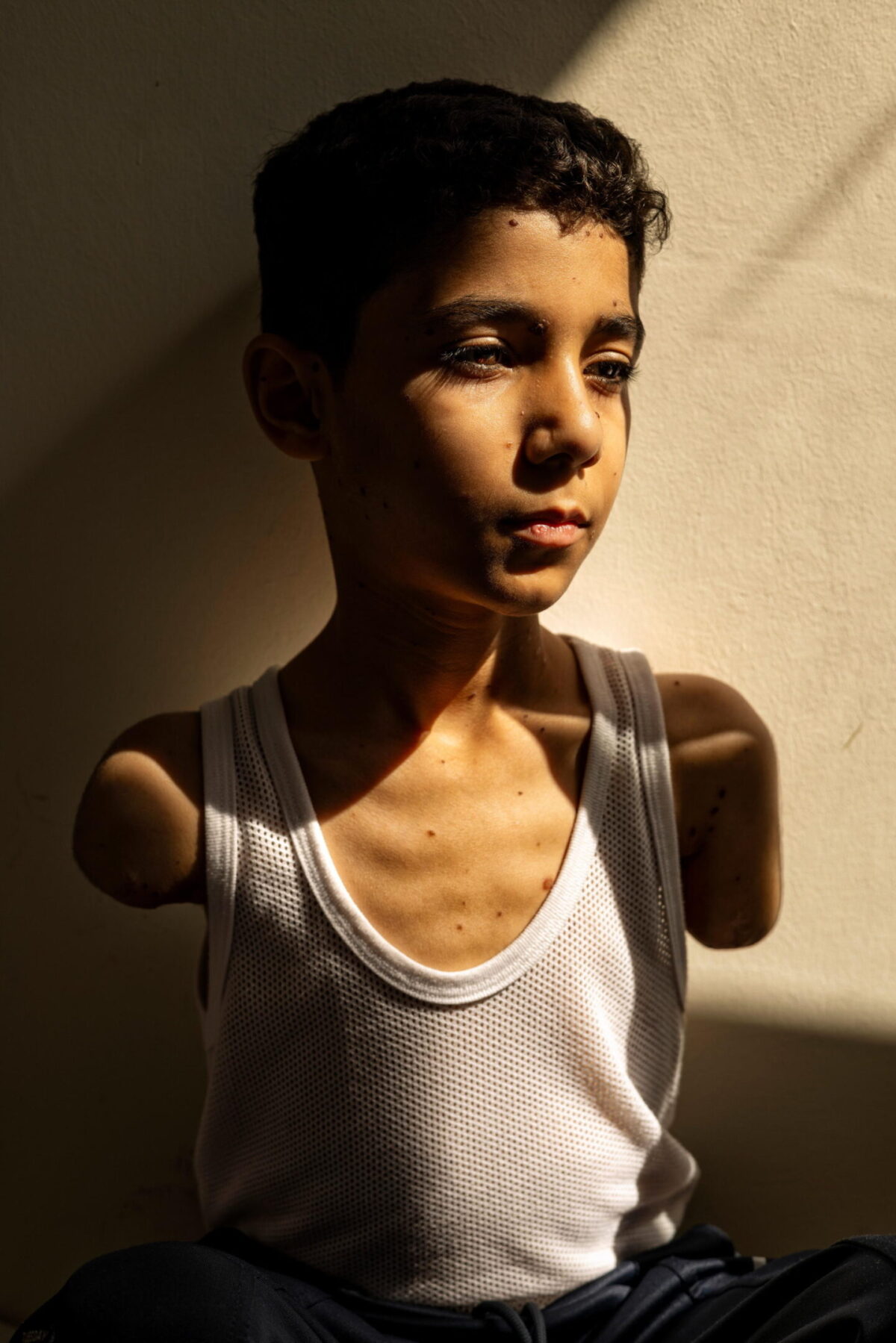World Press Photo 2025, la storia della foto del bambino amputato a Gaza