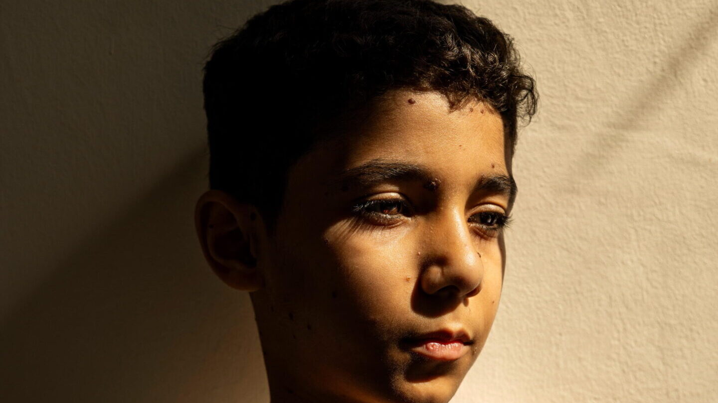 World Press Photo 2025, la storia della foto del bambino amputato a Gaza