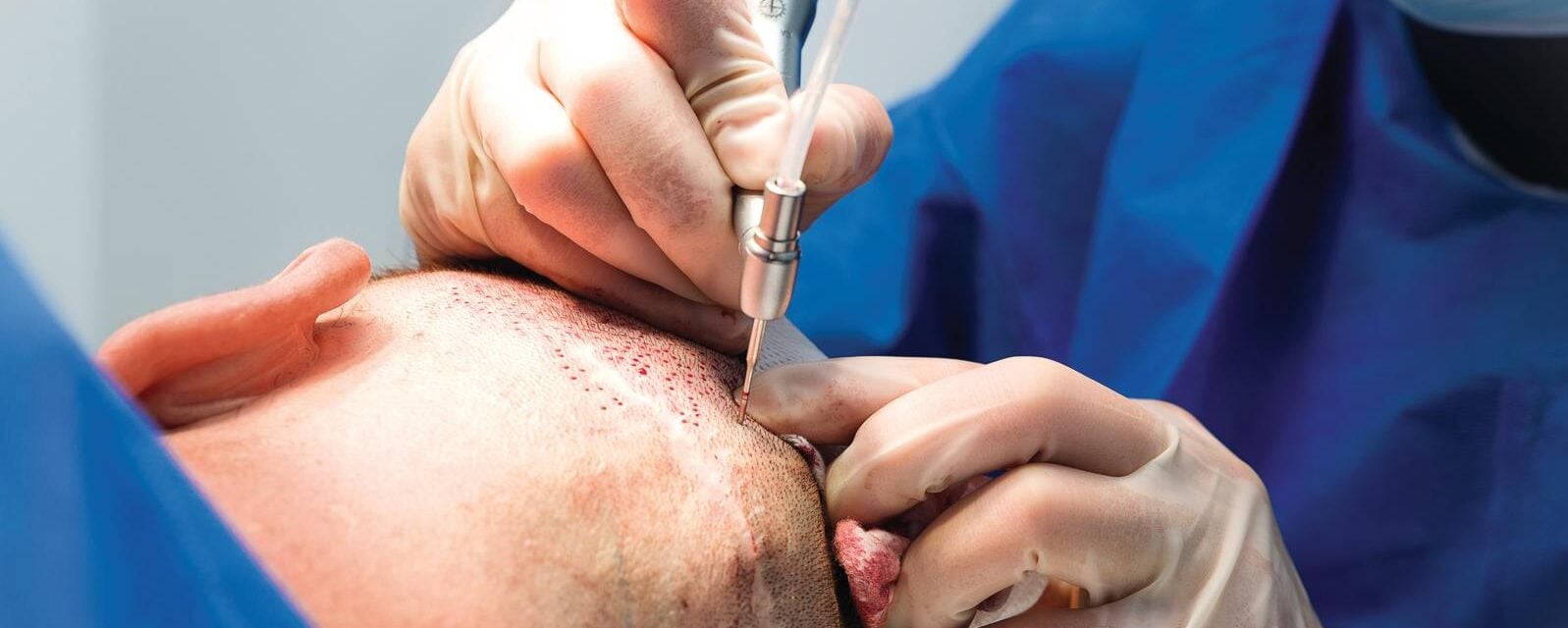 Boom dei trapianti di capelli: il nuovo business globale tra Istanbul e Italia