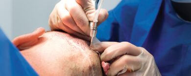 Il boom dei trapianti di capelli: la nuova ossessione maschile tra low cost, vip e rischi nascosti