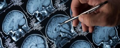 La rivoluzionaria pillola della memoria che mette l’Alzheimer in stand-by