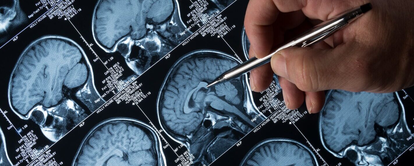 La rivoluzionaria pillola della memoria che mette l’Alzheimer in stand-by