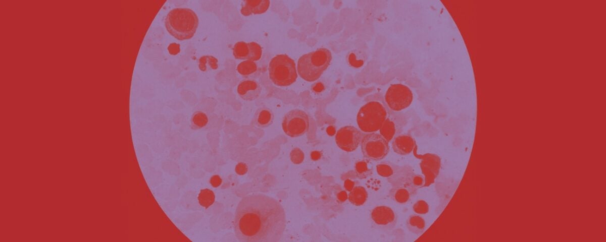 Mieloma multiplo, la terapia “one shot” ora è realtà: cosa cambia per i pazienti italiani