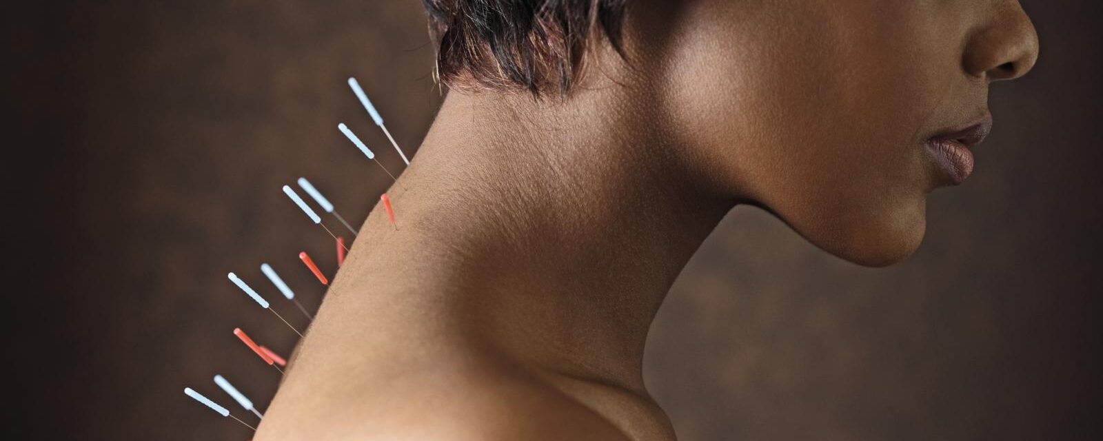 Salute in punta di ago: ecco perché l’agopuntura non è più una medicina alternativa Salute in punta di ago: ecco perché l’agopuntura non è più una medicina alternativa